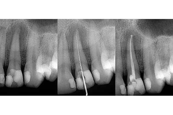 What is Root canal treatment?