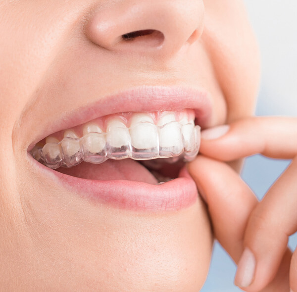 What happens during Clear Aligner Treatment?