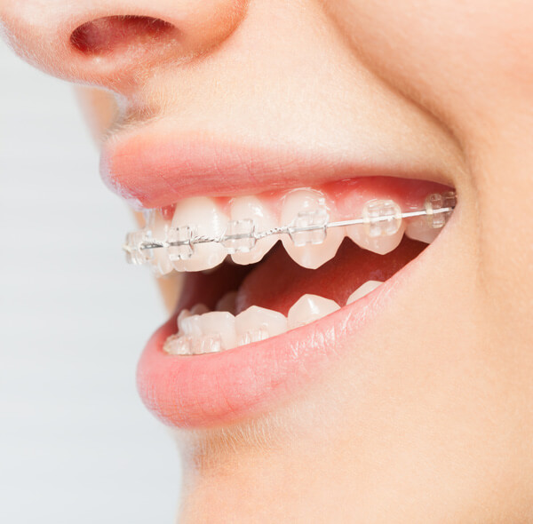 What happens during Orthodontic Treatment?