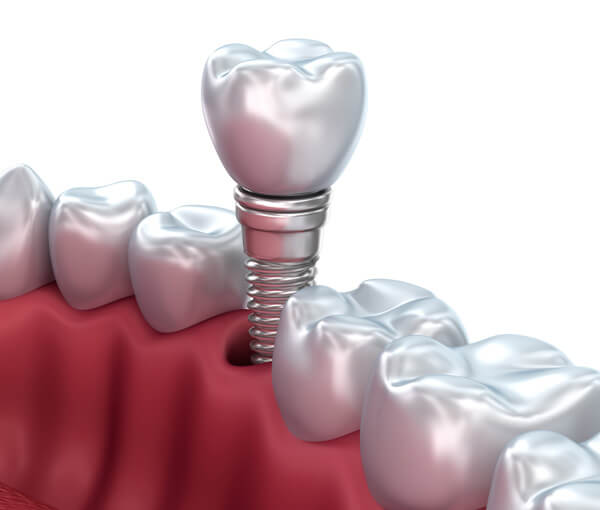 Why have dental implants?